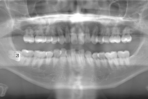 術前のレントゲン写真