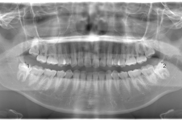 術前のレントゲン写真