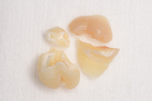 抜歯後の歯の写真