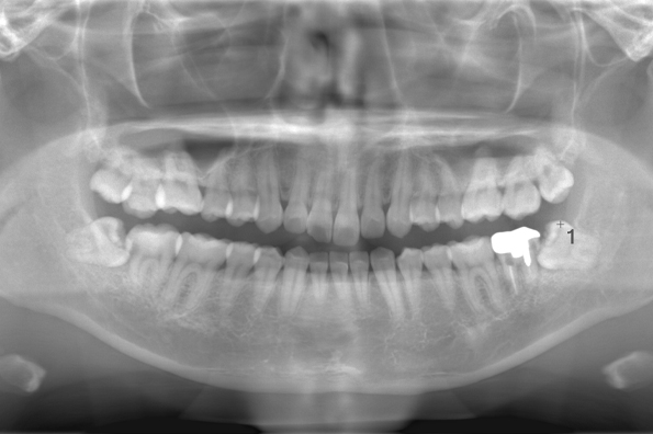 術前のレントゲン写真