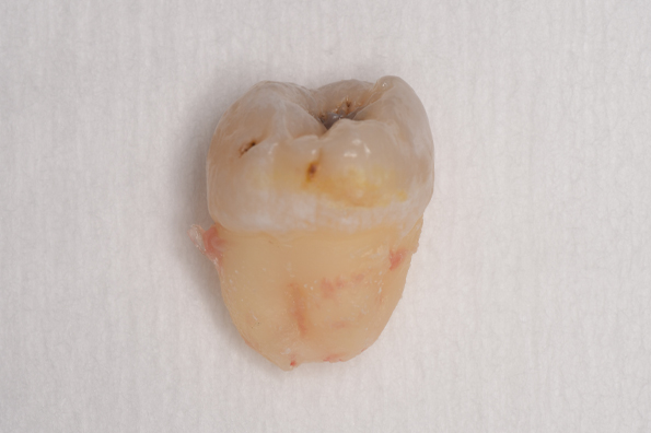 抜歯後の歯の写真