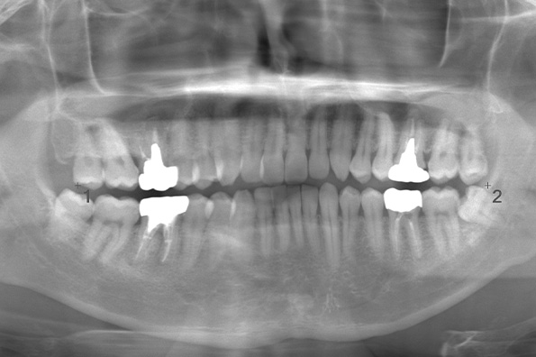 術前のレントゲン写真