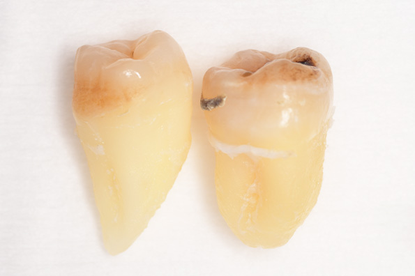 抜歯後の歯の写真