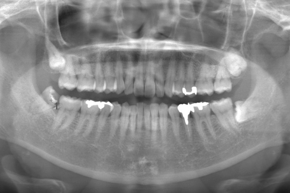 術前のレントゲン写真