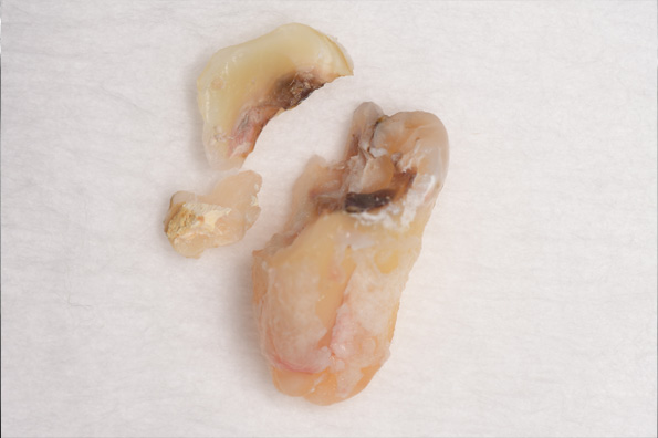 抜歯後の歯の写真