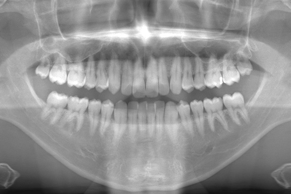 術前のレントゲン写真