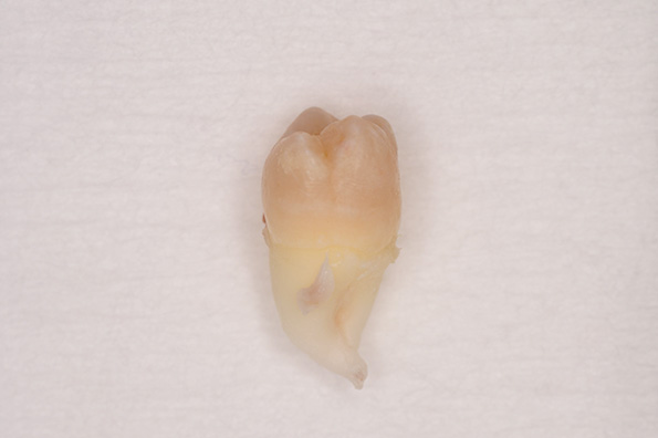 抜歯後の歯の写真