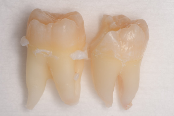 抜歯後の歯の写真