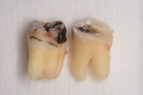 抜歯後の歯の写真