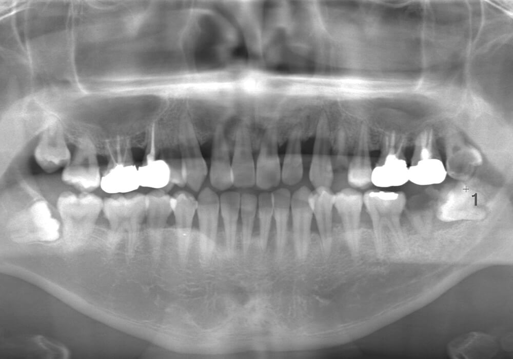 術前のレントゲン写真