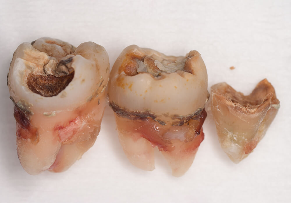抜歯後の歯の写真