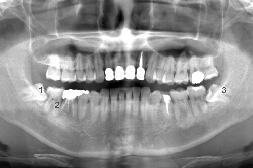 術前のレントゲン写真