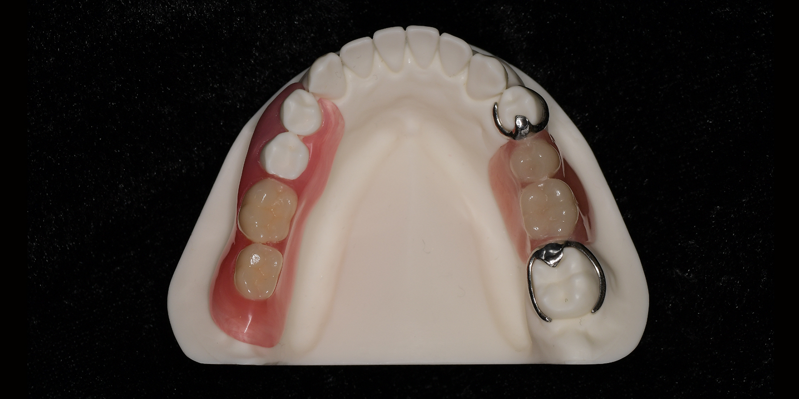 左右に分かれた下の部分入れ歯、左がワイヤーが目立たない入れ歯、右が保険適用のワイヤーが目立つ入れ歯