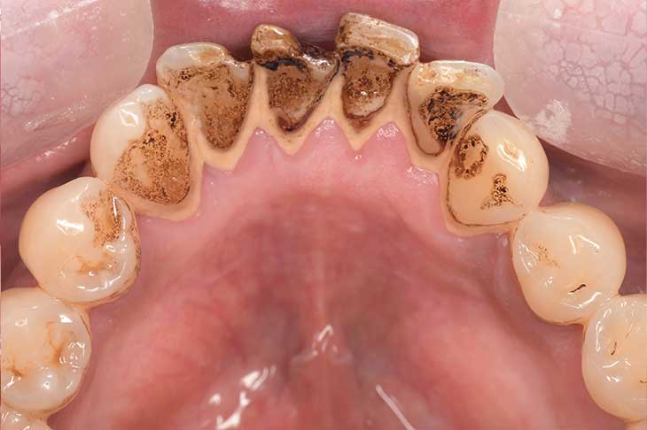 歯の表面についたステインがわかりやすい口の中の写真