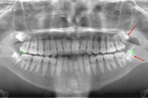 術前のレントゲン写真