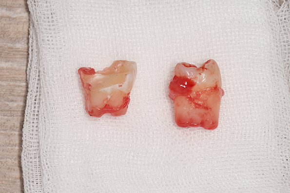 抜歯後の歯の写真