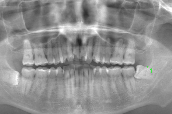 術前のレントゲン写真