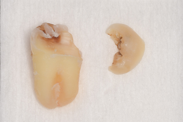 抜歯後の歯の写真