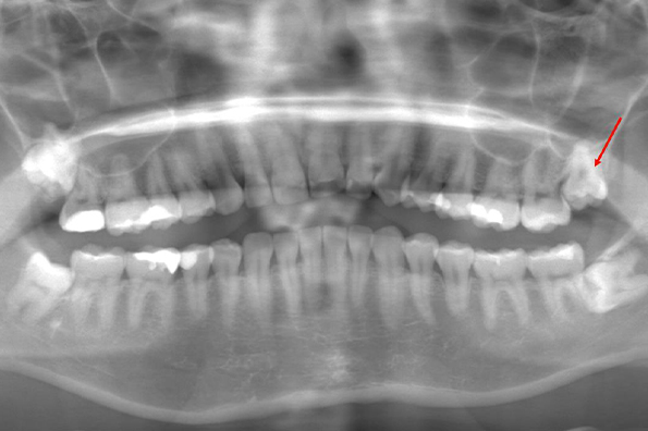 術前のレントゲン写真