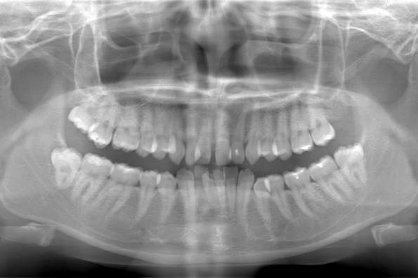 術前のレントゲン写真