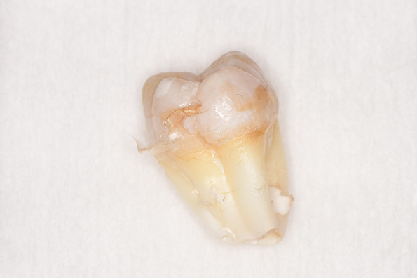 抜歯後の歯の写真