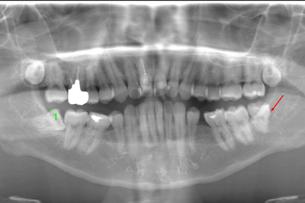術前のレントゲン写真