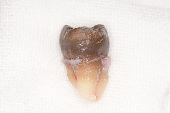 抜歯後の歯の写真