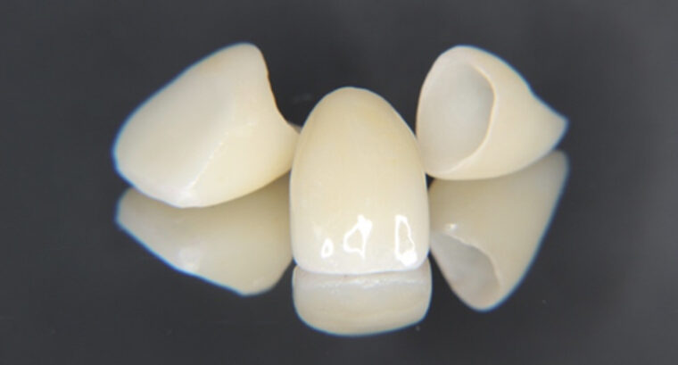 前歯のセラミックの補綴物の写真