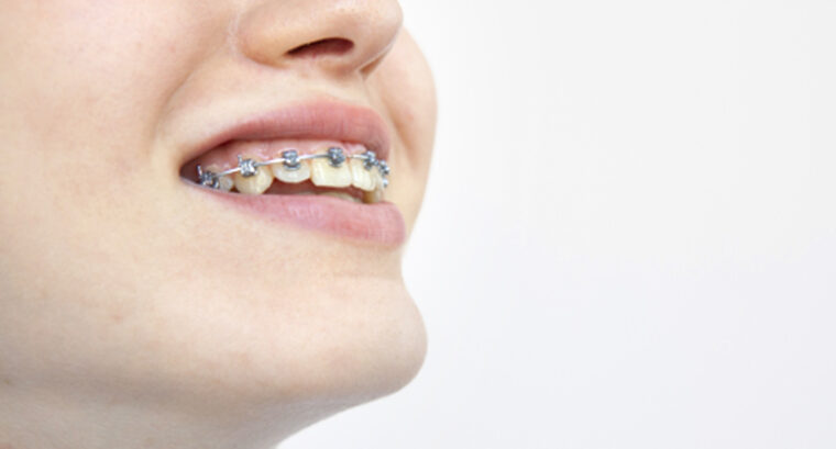 矯正器具のついた歯を見せている口元の写真
