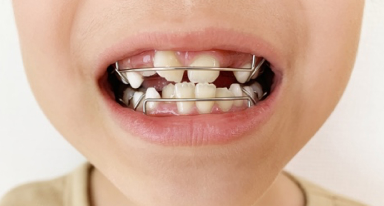 小児の歯列矯正治療の種類と開始時期、費用について