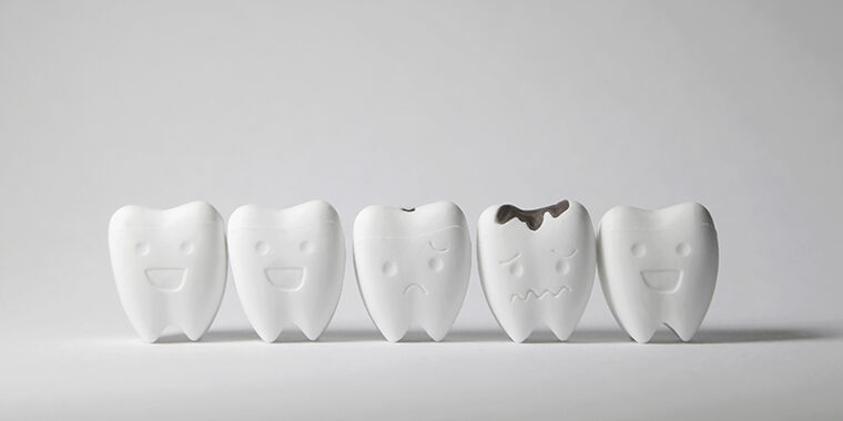 5本並ぶ歯の模型の内1本が虫歯になっている画像