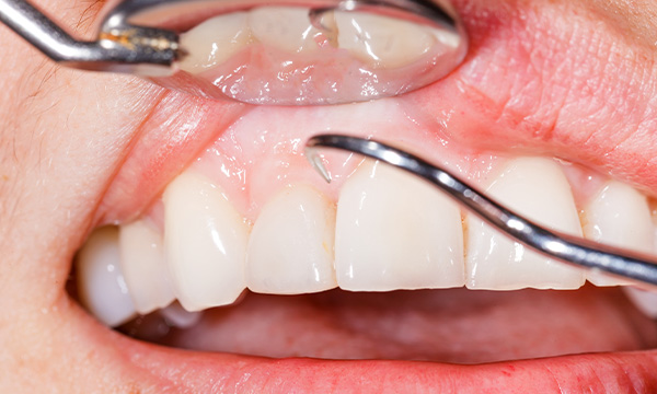 歯ぐきの状態をチェックされているイメージ