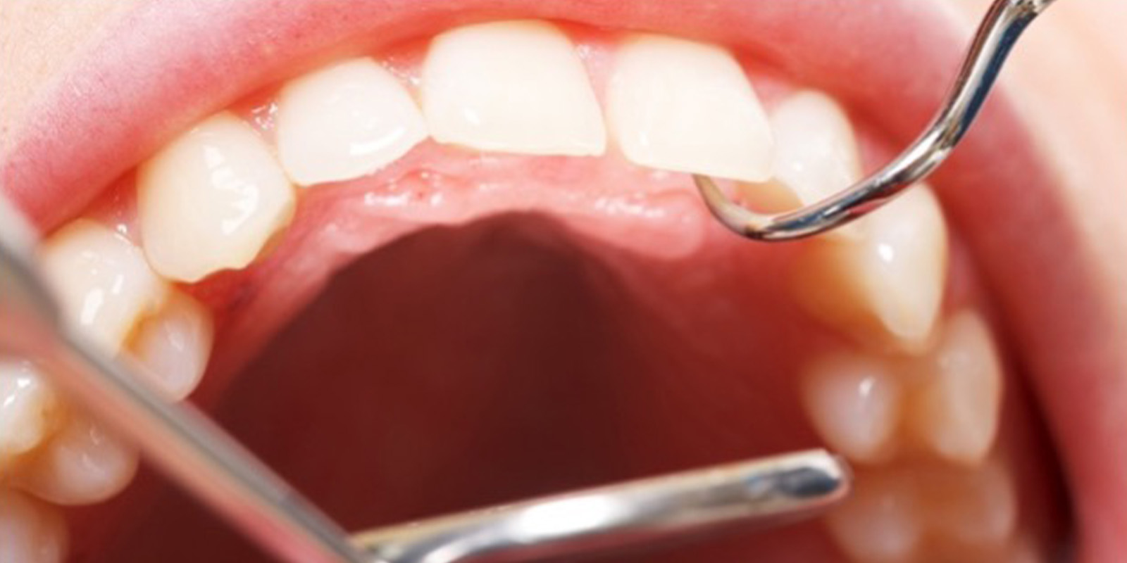 歯科医院で口腔内チェックを受けている様子