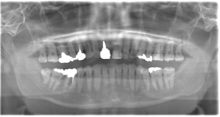 術前のレントゲン写真