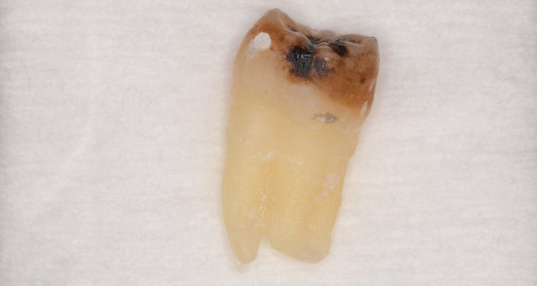 抜歯後の歯の写真