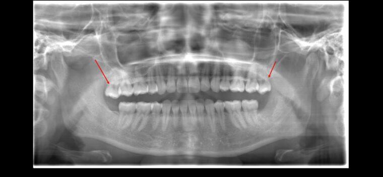 術前のレントゲン写真