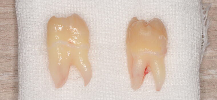 抜歯後の歯の写真