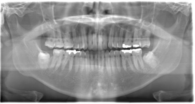 術前のレントゲン写真