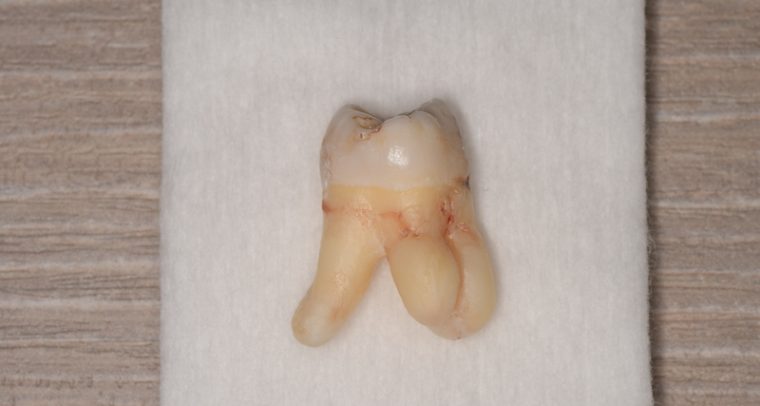 抜歯後の歯の写真