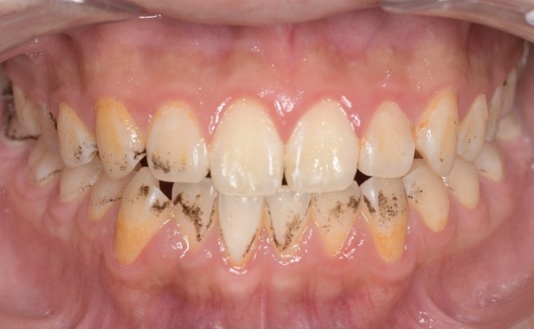 歯の表面についたステインがわかりやすい口の中の写真
