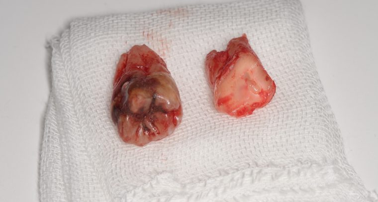 抜歯後の歯の写真