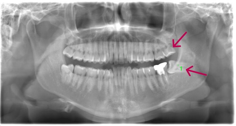 術前のレントゲン写真