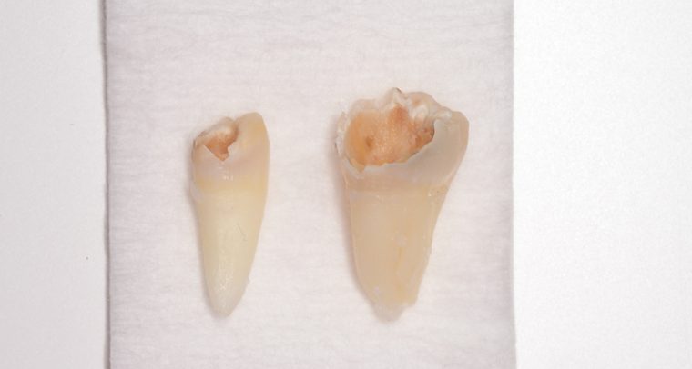 抜歯後の歯の写真