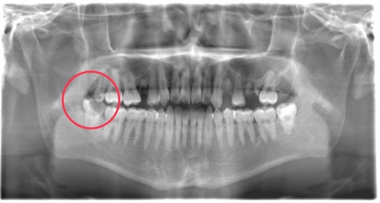 術前のレントゲン写真