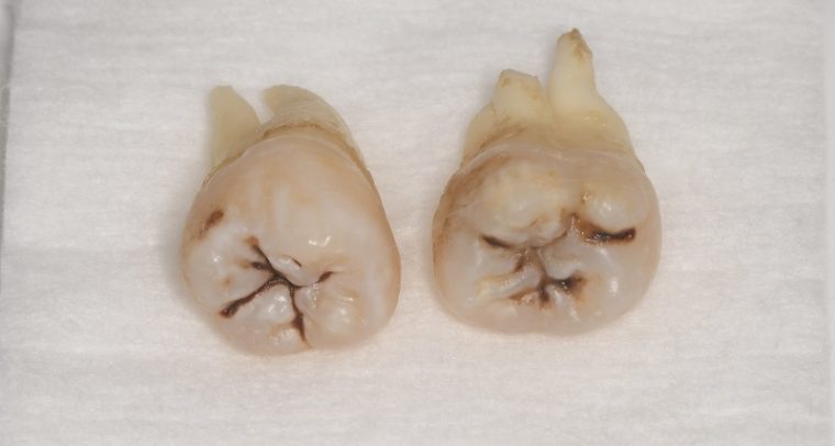 抜歯後の歯の写真