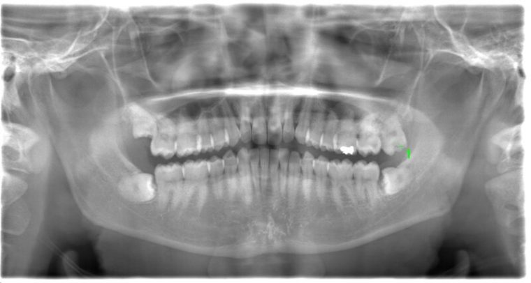 術前のレントゲン写真
