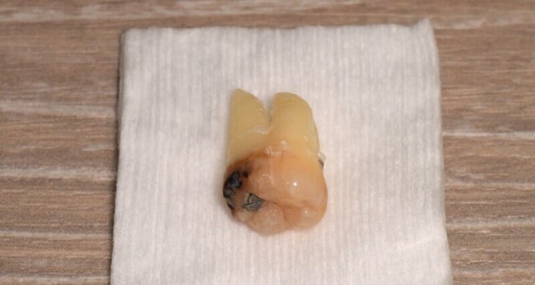 抜歯後の歯の写真