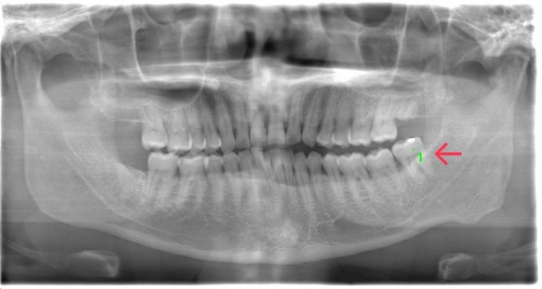 術前のレントゲン写真