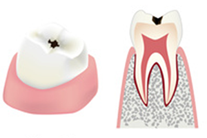 歯の表層のエナメル質に限局した虫歯（C1）のイメージ