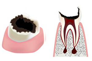 歯の頭の部分が虫歯により無くなってしまい、根だけが残った歯（C4）のイメージ